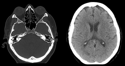 Компьютерная томография (МСКТ) головного мозга и черепа