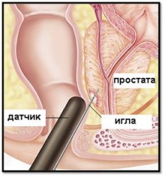 Биопсия предстательной железы
