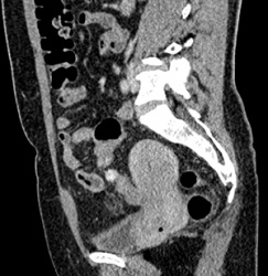 Компьютерная томография (МСКТ) органов малого таза