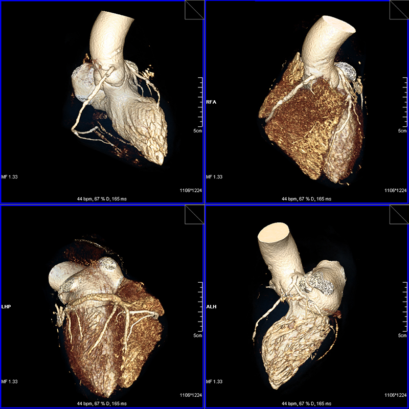 Кт сердца. Мультиспиральная кт сердца. Кт-ангиография коронарных артерий. МСКТ-коронарография сердца. Мультиспиральная кт ангиография.