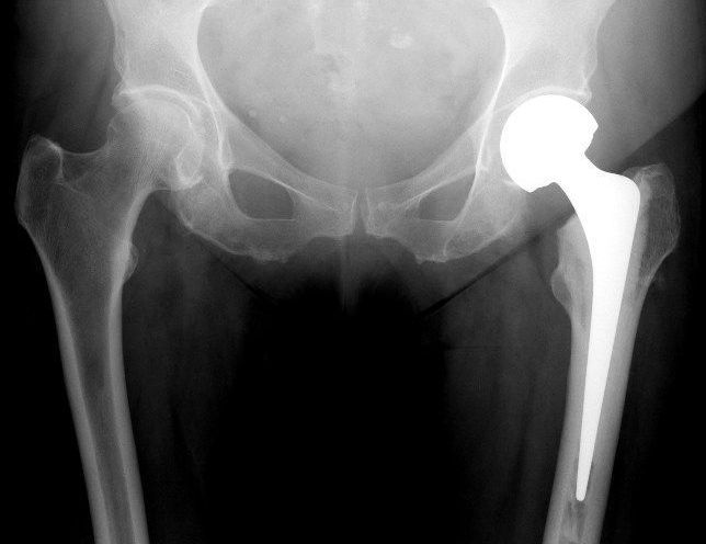 Шейка правого бедра. Оскольчатый перелом шейки бедра. Перелом тазобедренного сустава рентген. Рентген тазобедренного сустава перелом шейки бедра. Перелом шейки тазобедренного сустава рентген.