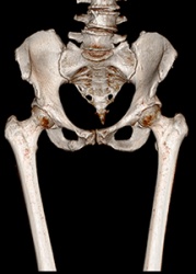Мультиспиральная компьютерная томография (МСКТ) костей 