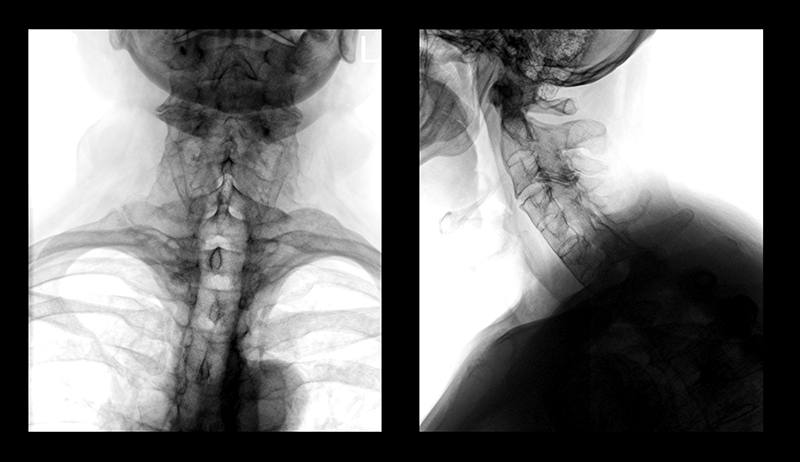Рентгенография шейного. Вывих шеи рентген. Рентген шейного отдела с функциональными пробами. Рентген с пробами шейного отдела. Функциональная рентгенография шейного отдела позвоночника.