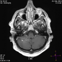 МРТ головного мозга 