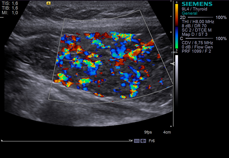Цдк щитовидки. УЗИ щитовидной железы ЦДК что это. УЗИ щитовидной железы в режиме ЦДК. Цветное допплеровское картирование щитовидной железы. УЗИ щитовидной железы с цветным допплеровским картированием.