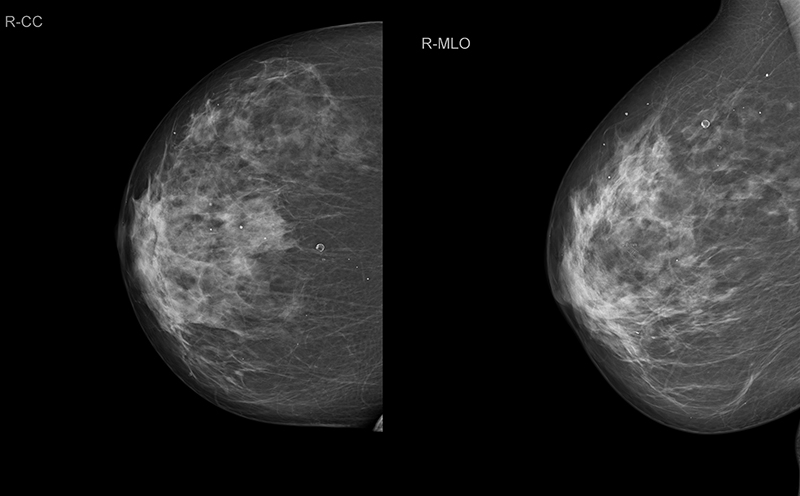 Маммография ответы. Молочная железа маммография. Рик молочной железы маммографич. Мастопатия на маммографии. Норма молочной железы маммограмма.