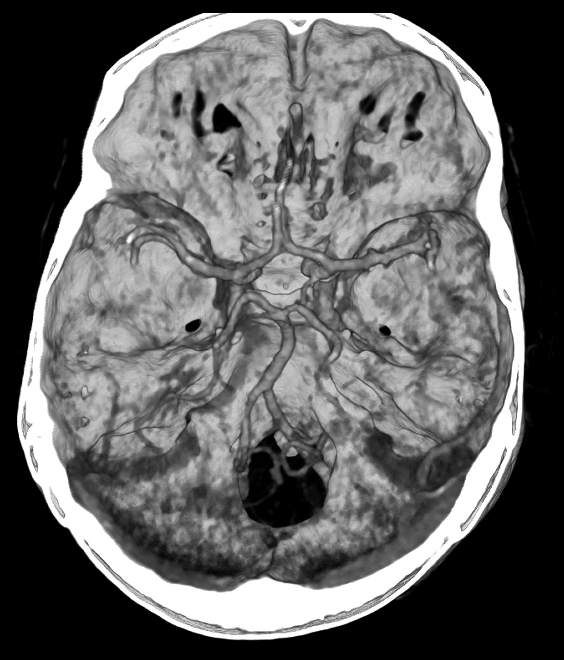 Кт головы стоя. Кт томограмма головного мозга. СКТ головного мозга. СКТ головного мозга снимок. Кт и мрт головного мозга.
