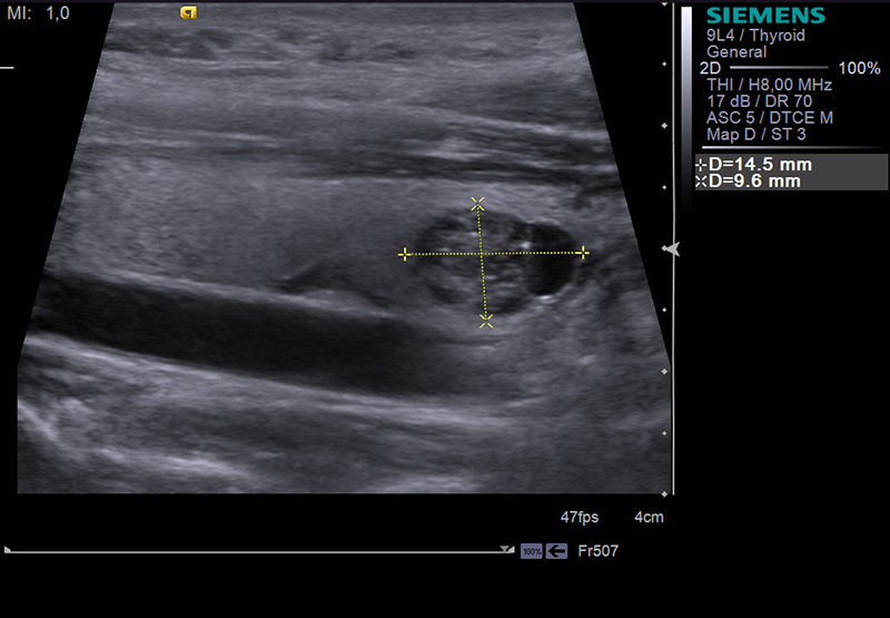 Рак щитовидной железы узи картина
