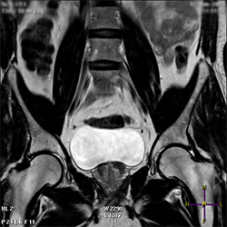 Магнитно-резонансная томография (МРТ) органов малого таза 
