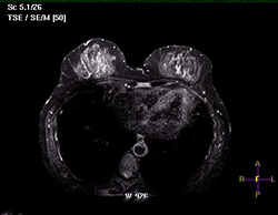 Магнитно-резонансная томография (МРТ) молочных желез 