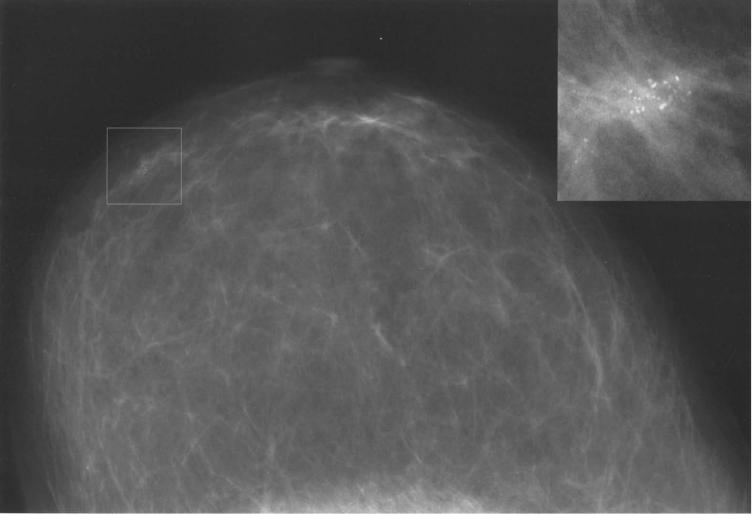 Рак молочной железы фото начальная стадия фото как выглядит как